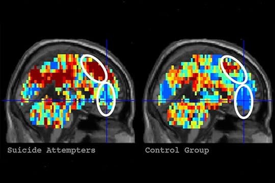 Image result for mri of the brain, suicidal thoughts