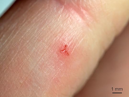 leech bite