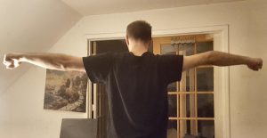 disfigured arm