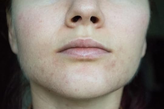 merilin-taimre-paljas-porgand-keemiline koorimine-armid-dr-hauschka-endokrinoloog-akneravi-jaanus-kerge-nägu-vistrik-punn-akne-punetav-nahk-ebaühtlane-blogi-ilu