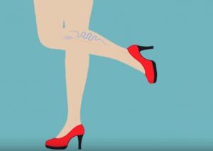 4 Myths About Varicose Veins