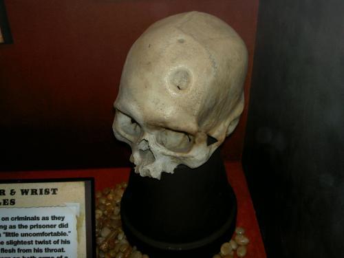 trepanation