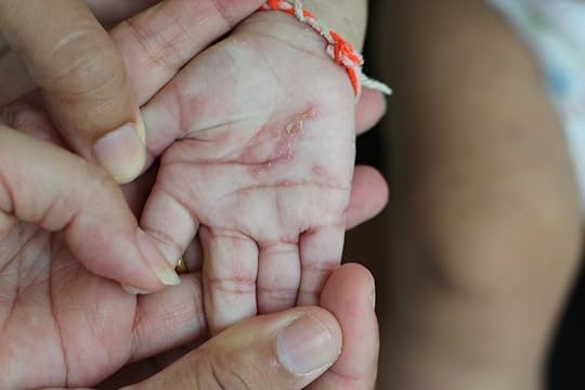 Child infected with scabies