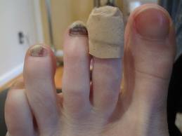 1toe