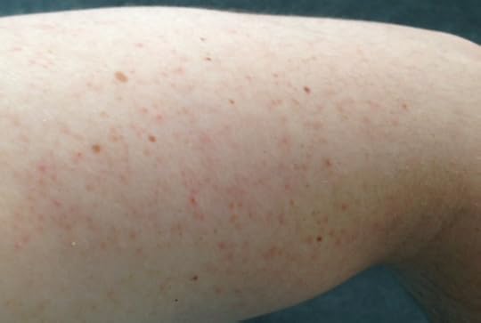 merilin-taimre-paljas-porgand-keratosis-pilaris-medemis-clinic-ilu-kliinik-laser-foto-noorendus-ravi
