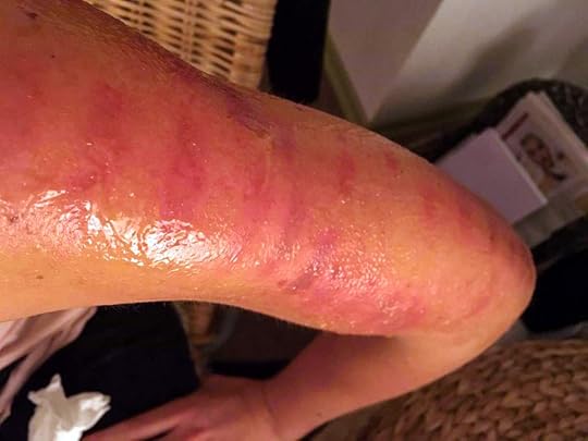 merilin-taimre-paljas-porgand-keratosis-pilaris-medemis-clinic-ilu-kliinik-laser-foto-noorendus-ravi