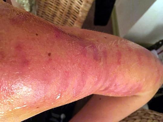 merilin-taimre-paljas-porgand-keratosis-pilaris-medemis-clinic-ilu-kliinik-laser-foto-noorendus-ravi