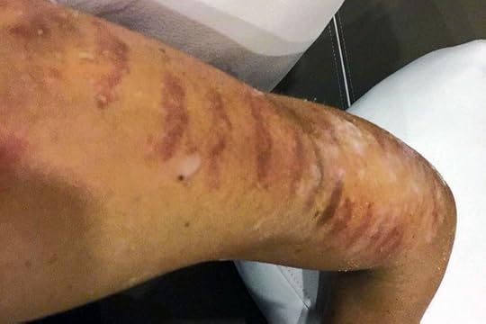 merilin-taimre-paljas-porgand-keratosis-pilaris-medemis-clinic-ilu-kliinik-laser-foto-noorendus-ravi