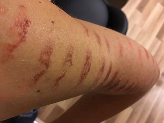 merilin-taimre-paljas-porgand-keratosis-pilaris-medemis-clinic-ilu-kliinik-laser-foto-noorendus-ravi