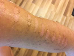 merilin-taimre-paljas-porgand-keratosis-pilaris-medemis-clinic-ilu-kliinik-laser-foto-noorendus-ravi
