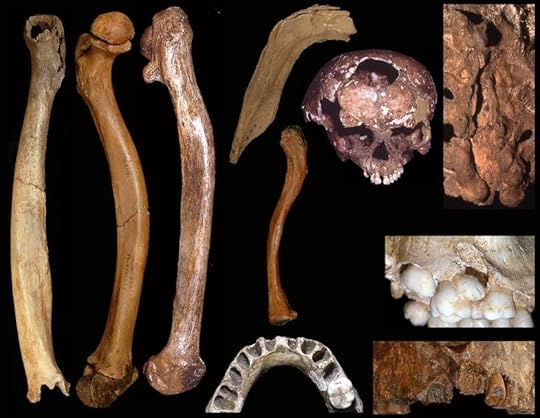 Some examples of developmental abnormalities in Pleistocene people.