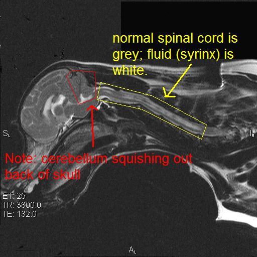 Risonanza magnetica di un Cavalier King Charles con siringomielia. Cerchiato in rosso il cervelletto che protrude dal forame magno, cerchiate in giallo zone grigio chiaro di degenerazione del midollo spinale. Fonte: https://cavalierhealth.org/index.html
