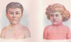 Illustrations of children with measles and scarlet fever (Sue Clark/CC BY 2.0)