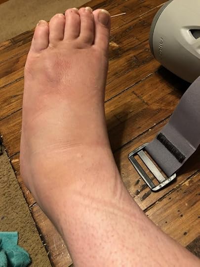 My foot, propped up on a wooden table with the air cast slightly in the photo. My foot is hugely swollen, bruised, and there's a weird lumpy sticking-up part about an inch below my fourth and fifth toe.