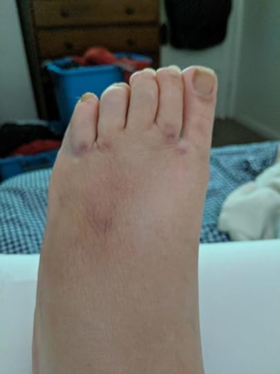 My foot propped up on a wedge pillow with bruises on the top of my foot and across the base of my toes.
