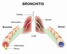 bronchitis