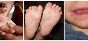 hand foot and mouth disease