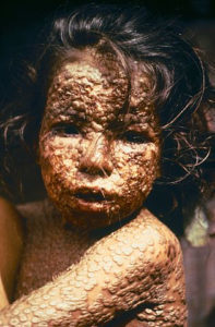 Child with active smallpox (Image:CDC/James Hicks)