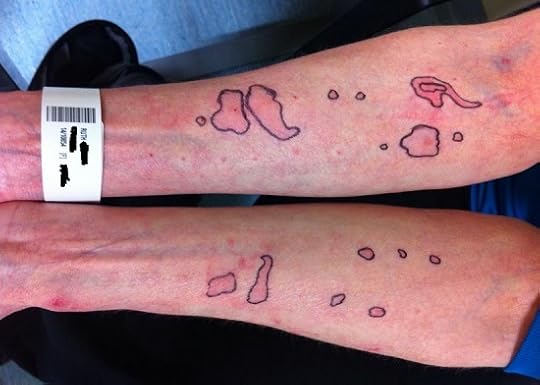 Skin prick test results
