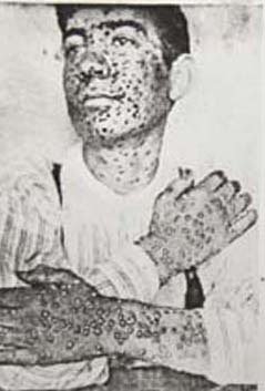 1880s Smallpox Victim