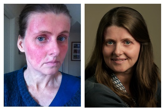 How Protopic healed my facial eczema