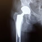 My New Hip
