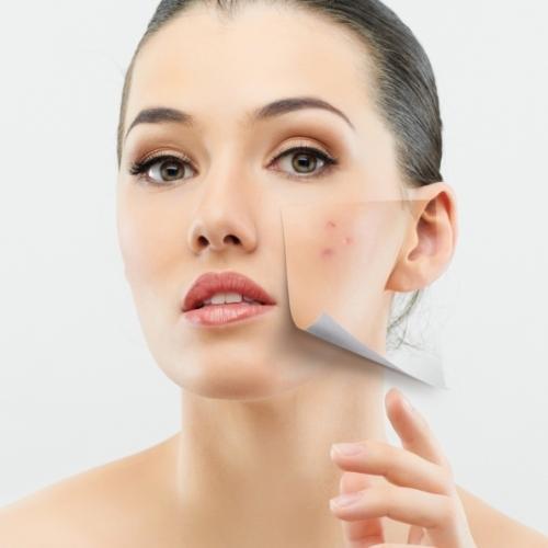 acne treatment pune