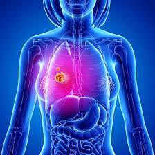 lung cancer treatment