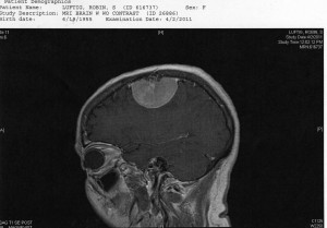Brain tumor