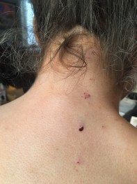 Photo of back of head and neck. The hair is pulled up. There are six small injection sites going up along the right side of the spine from shoulders to into hairline..