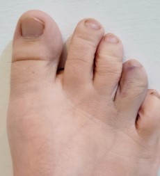broken toe