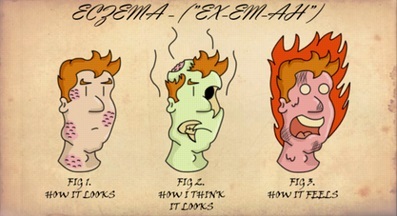 Eczema cartoon