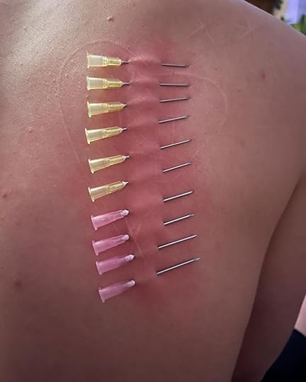 image of David's back with ten needles inserted into their skin