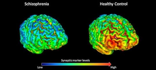 New study finds evidence for reduced brain co | EurekAlert!