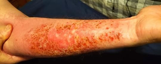 Poison Ivy Rash Arm 1