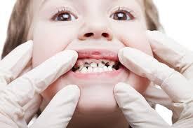 Symptoms of Early Stage Tooth Decay ...
