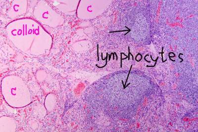 Hashimotos Thyroiditis, Manic Depression, Psychosis and Psychiatric Manifestations