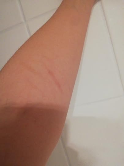 How do scars heal? Quora