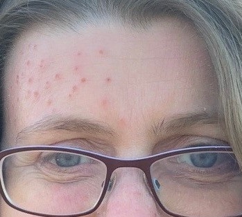 eczema herpeticum in latter stages