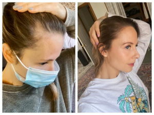 can you stop hormonal hair loss