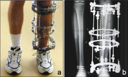2: a) An Ilizarov fixator, commonly used in the stabilization of bone... | Download Scientific Diagram