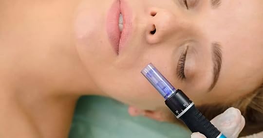 A white girl during microneedling sessoon