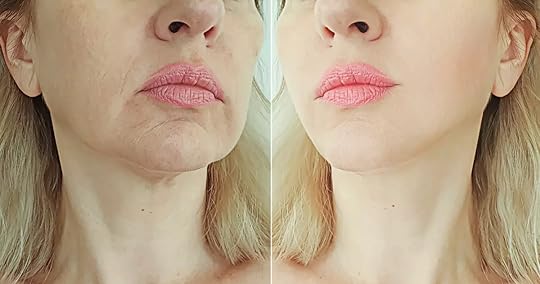 RF Microneedling Before and After