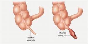 Appendix Facts, Functions of Appendix, Location and Pictures