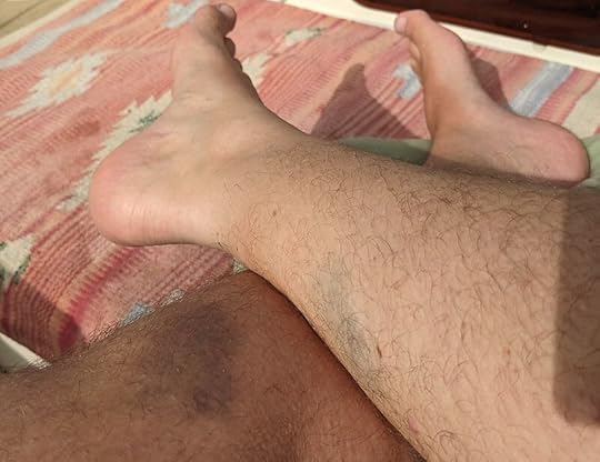 Dena Hankins, bruise collector...