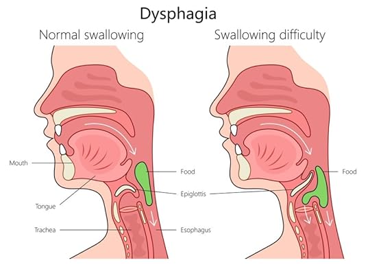 Dysphagia diagram