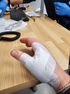 Picture of a hand with dressings over the thumb and palm