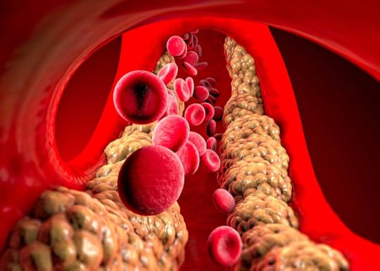 High Triglycerides