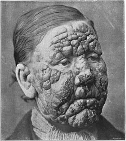 A historical portrait of a man with pronounced skin lesions, showcasing a distinctive facial texture and expression.