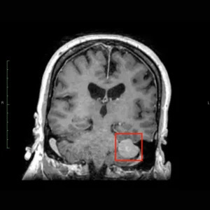 Brain MRI showing a tumor (outlined in red) sitting at the base of the skull and pressing on the cerebellum — the part of the brain that controls balance and coordination.